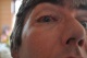 20-08-2011, Oog 4 dagen na de operatie