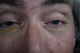 27-03-2015, Ogen gecontroleerd - staar toegenomen